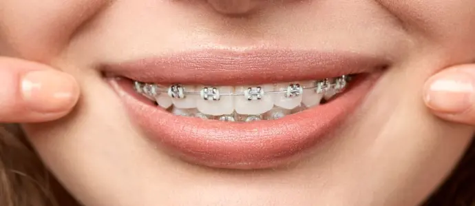 Bagues orthodontiques en métal Bagues orthodontiques en métal