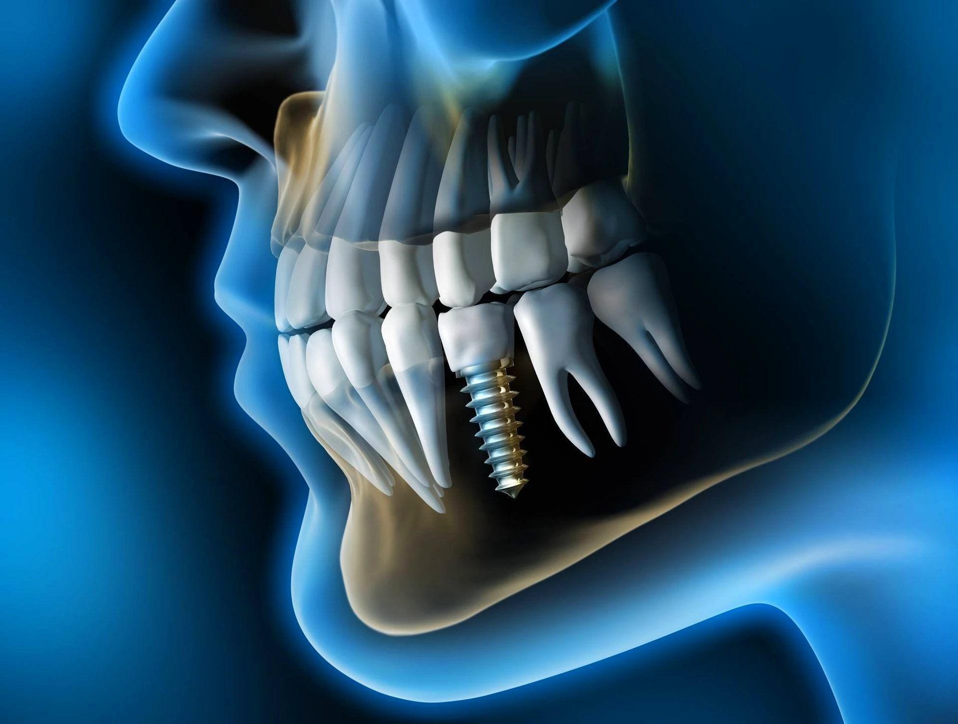 Implant dentaire Implant dentaire