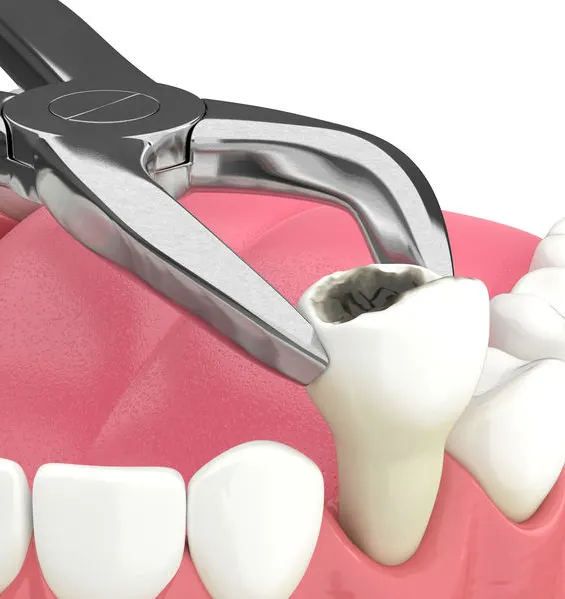 Extraction des dents Extraction des dents
