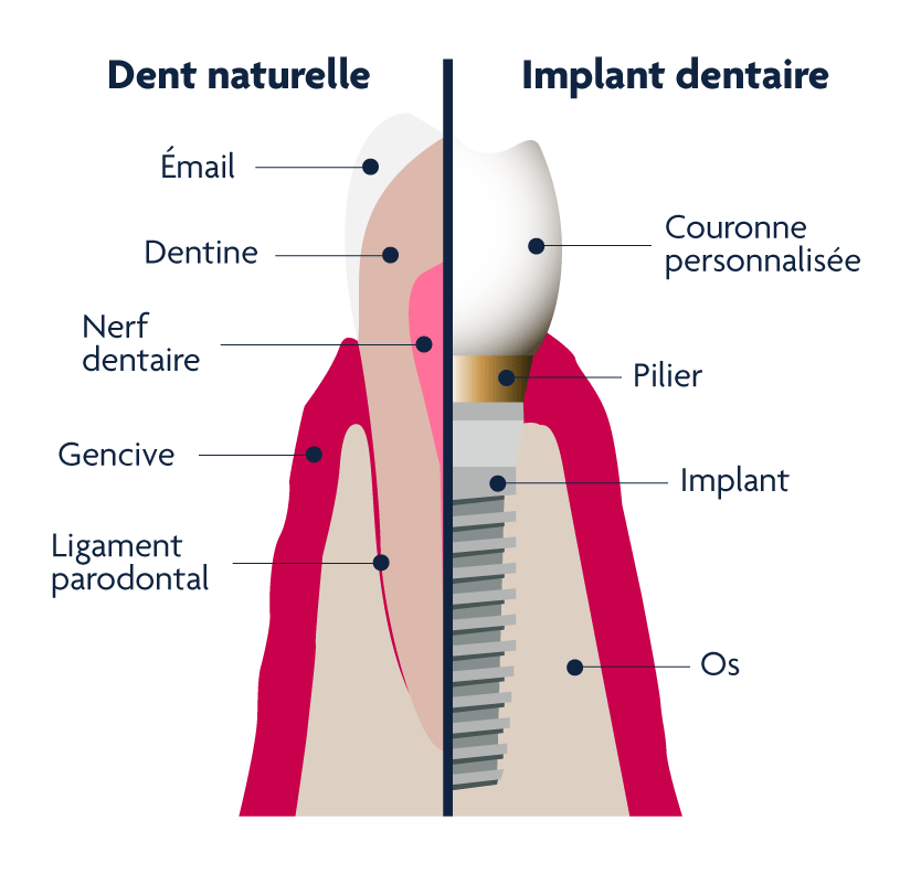 Composition d'un implant dentaire
