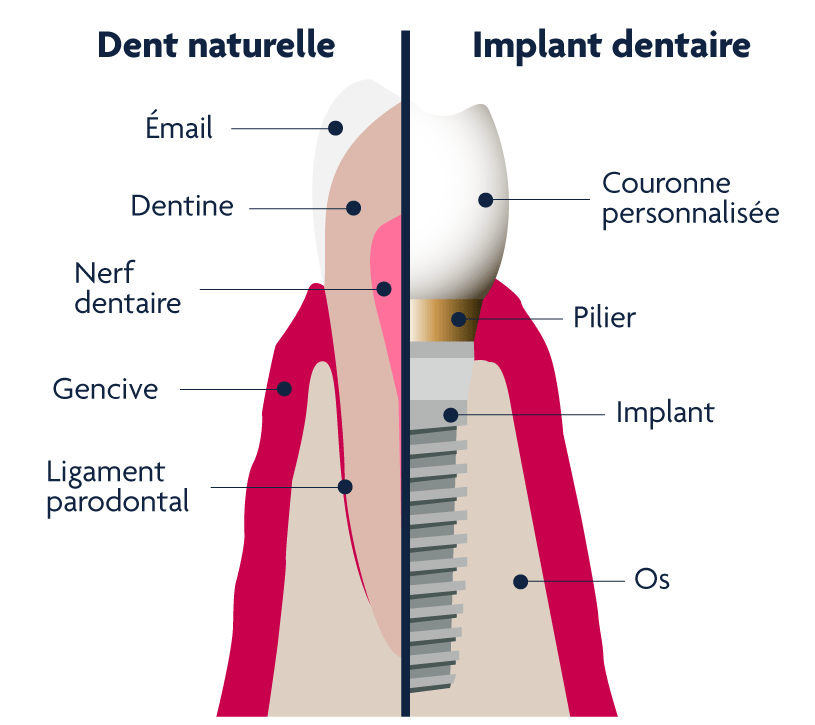 Composition d'un implant dentaire