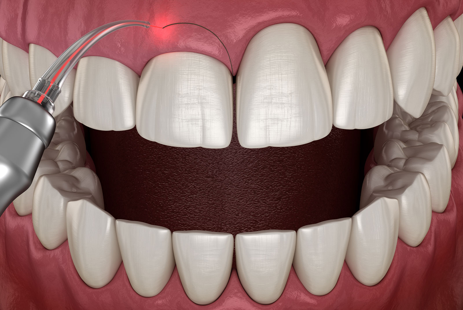 Gingivectomie Gingivectomie