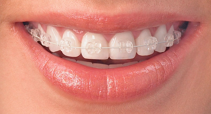 Bagues orthodontiques en céramiques Bagues orthodontiques en céramiques